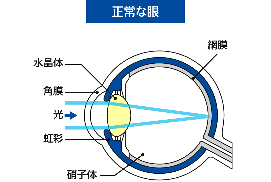 正常な眼