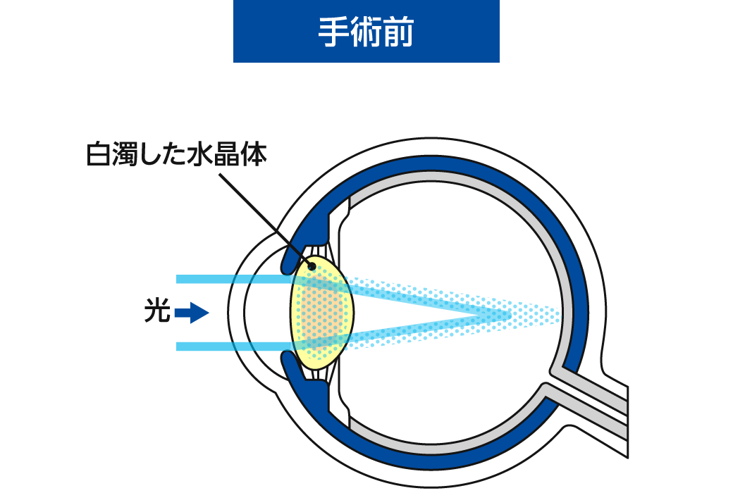 当院の白内障手術について 手術前