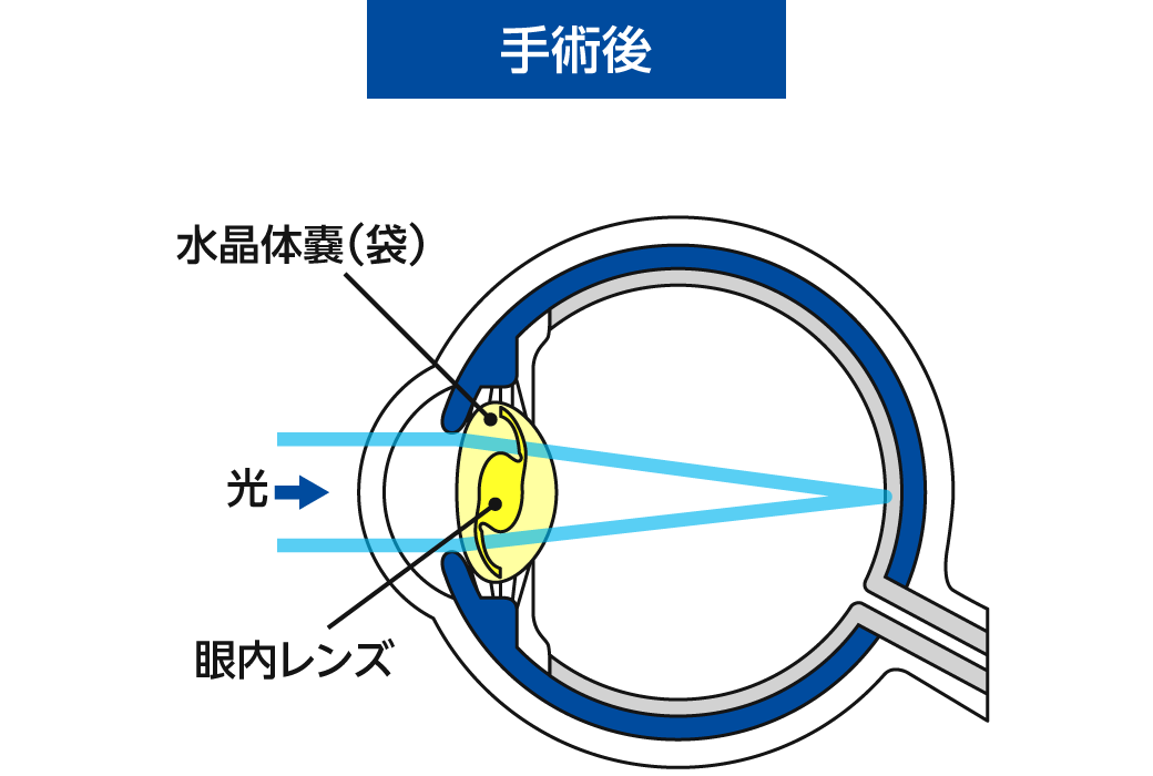 当院の白内障手術について 手術後