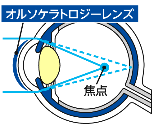 夜:レンズ装用中