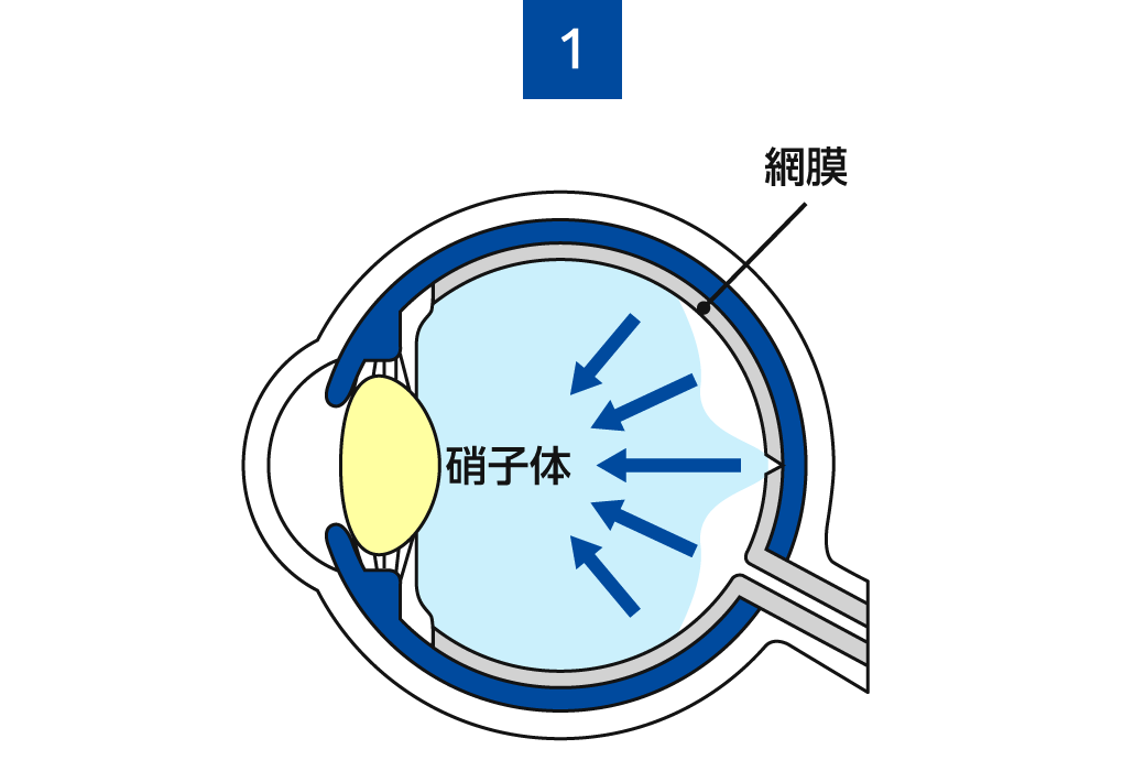 黄斑円孔1