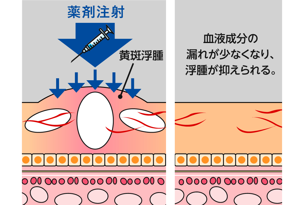 抗VEGF薬の働き